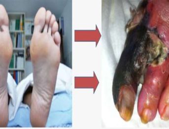 foot ulcer