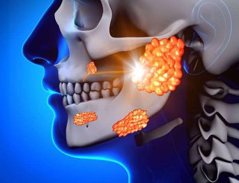 Mumps / Parotid Gland - Sickness